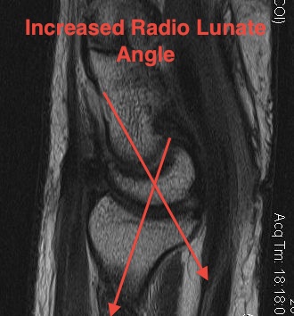 Increased Scapholunate Angle